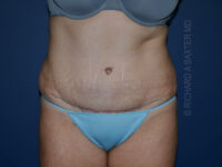 after tummy tuck front view female patient case 3340