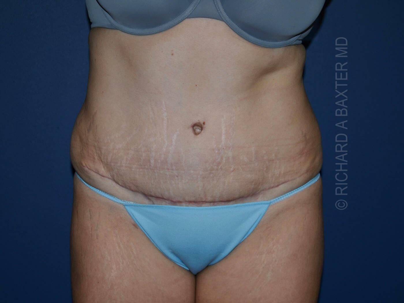after tummy tuck front view female patient case 3340