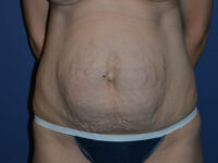 before tummy tuck front view female patient case 3369