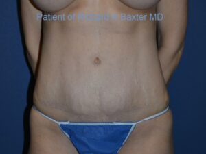 after tummy tuck front view female patient case 3369