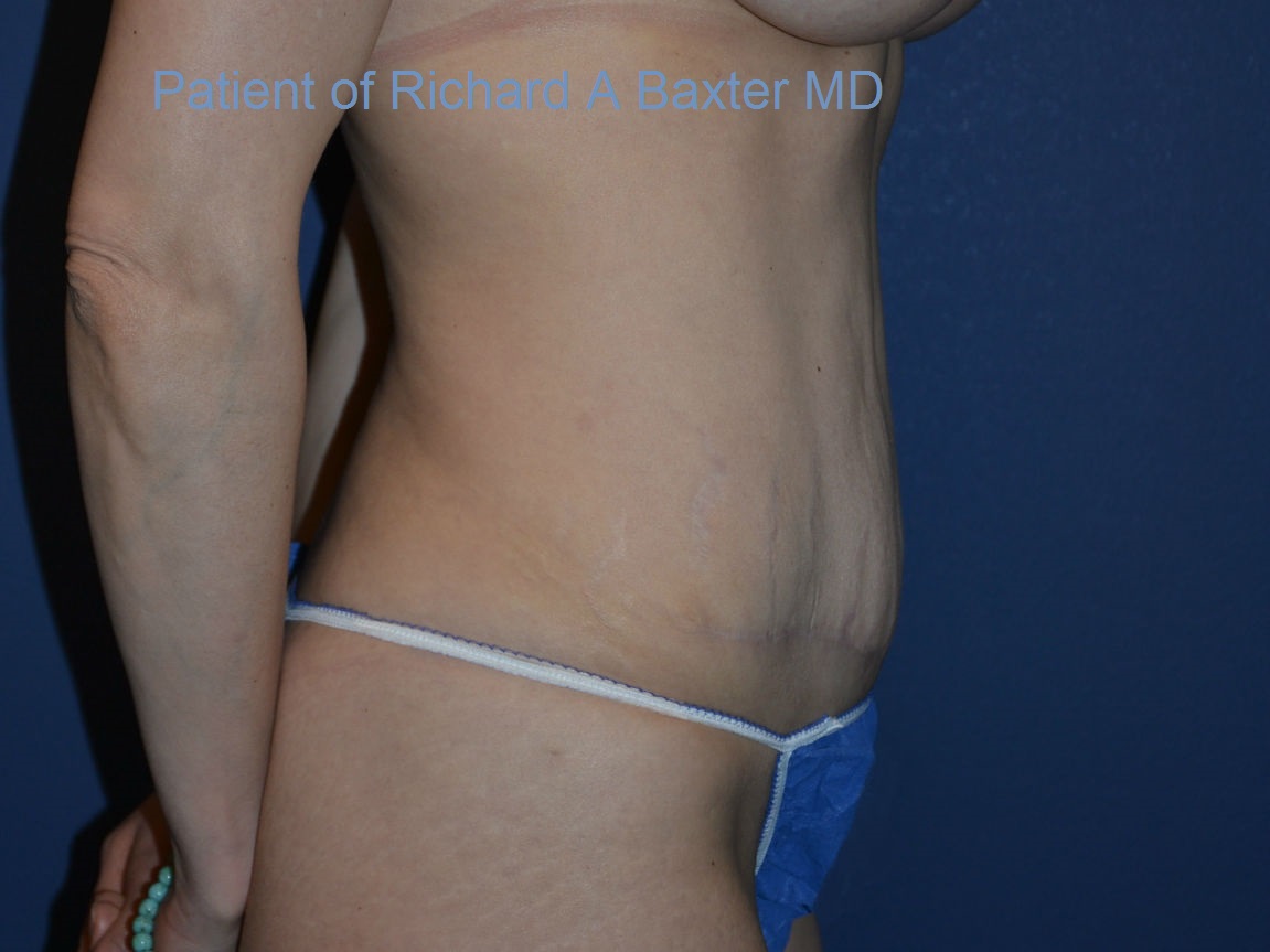 after tummy tuck right side view female patient case 3369