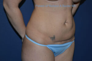 before tummy tuck angle view female patient case 3201
