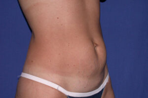 before tummy tuck angle view female patient case 3210