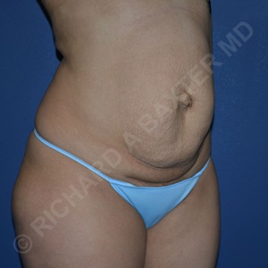 before tummy tuck angle view female patient case 3136