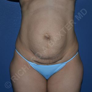 before tummy tuck front view female patient case 3136