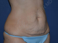 before tummy tuck female patient right angled view case 3340