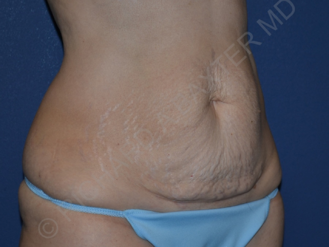 before tummy tuck female patient right angled view case 3340