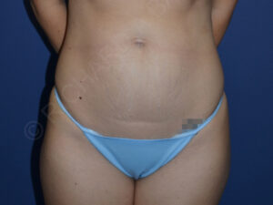 before tummy tuck female patient front view case 3177