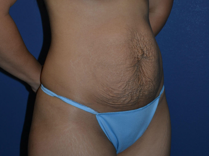 before tummy tuck female patient right angle view case 3157