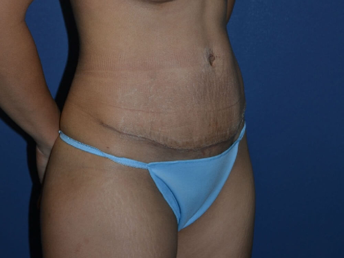 after tummy tuck female patient right angled view case 3157