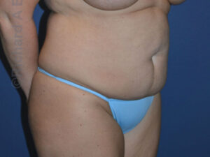 before tummy tuck female patient right angled view case 3165