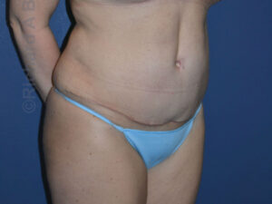 after tummy tuck female patient right angle view case 3165