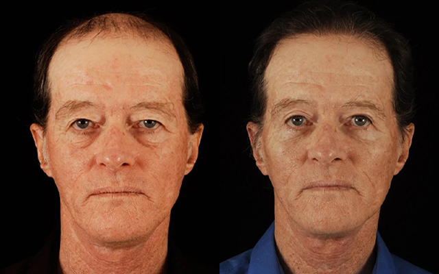 before and after cheek augmentation male patient front view