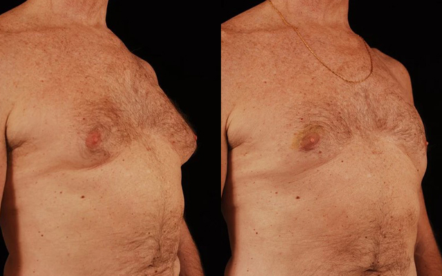 before and after gynecomastia male patient right angle view