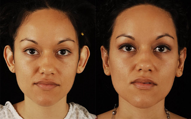 before and after otoplasty female patient front view