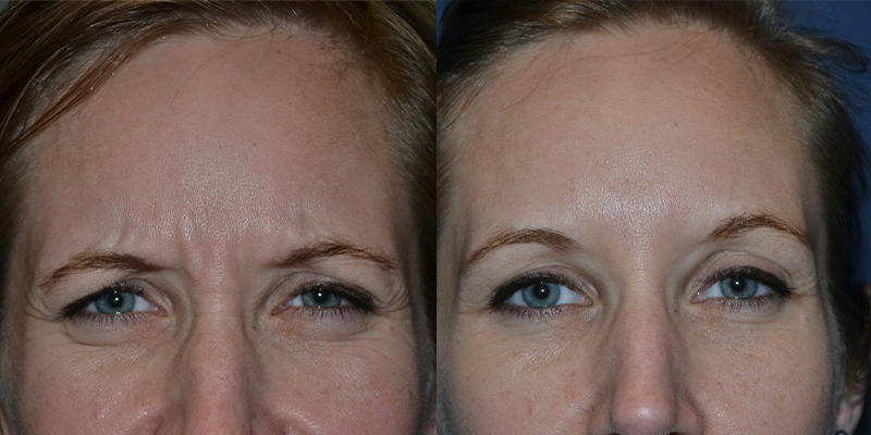 before and after dermal fillers front view