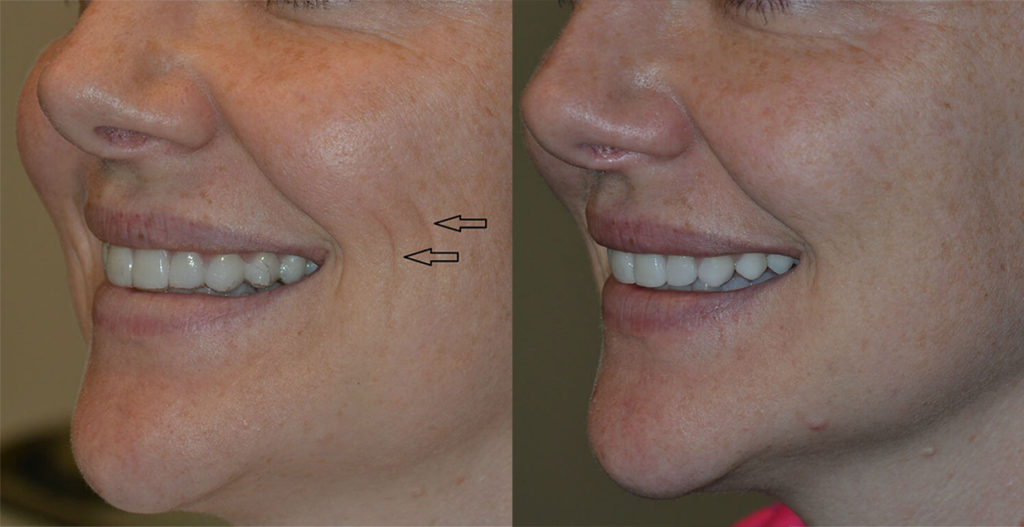 before and after dermal fillers left angle view