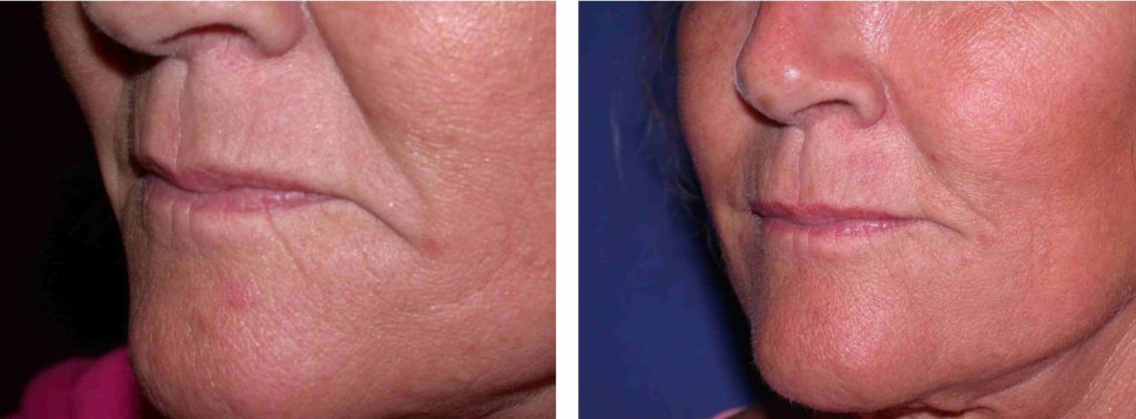 before and after dermal fillers left angle view