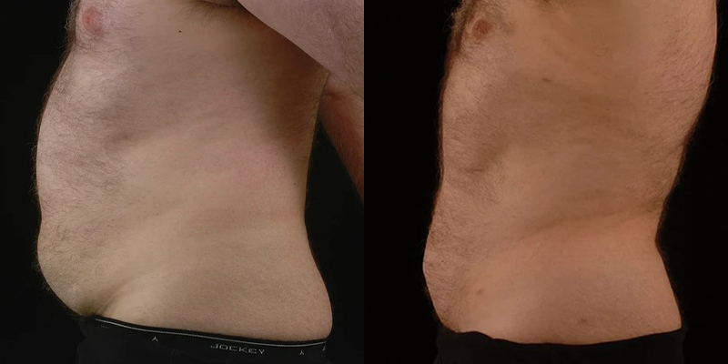 before and after liposuction male patient left side view