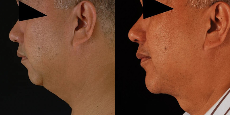 before and after liposuction male patient left side view