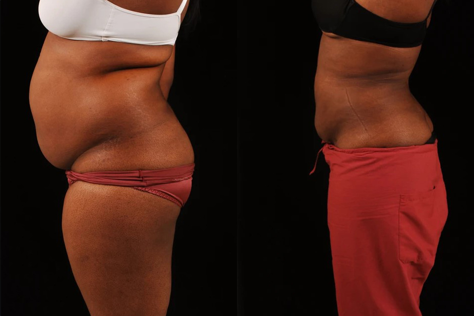 before and after liposuction female patient left side view