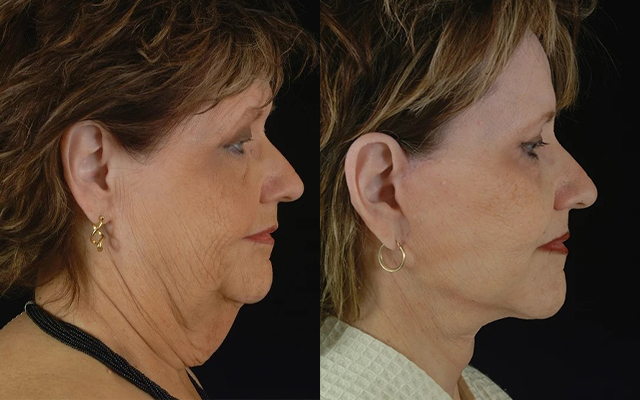 before and after facelift | neck lift female patient right side view