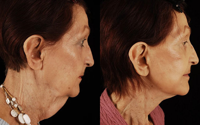 before and after facelift | neck lift female patient right side view