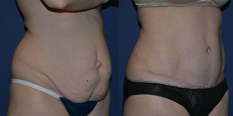 before and after tummy tuck female patient right angle view