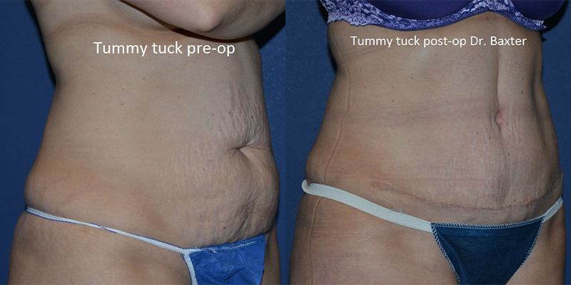 before and after tummy tuck female patient right angle view