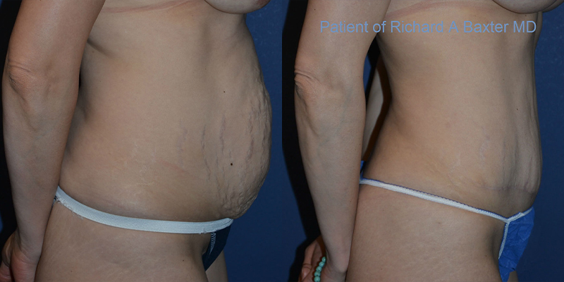 before and after tummy tuck female patient right angle view