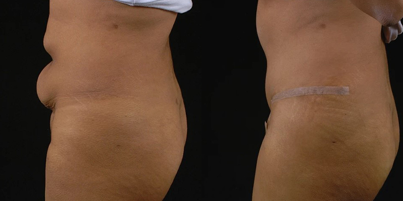 before and after tummy tuck female patient left side view