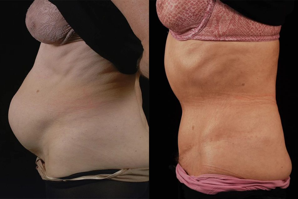 Seattle Liposuction Abdomen & Waist