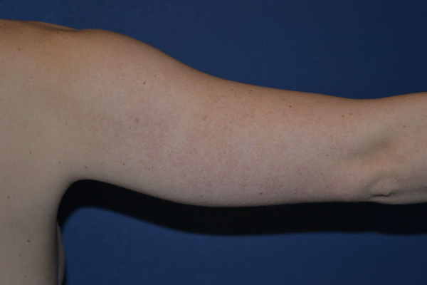 before arm lift right arm view case 4079