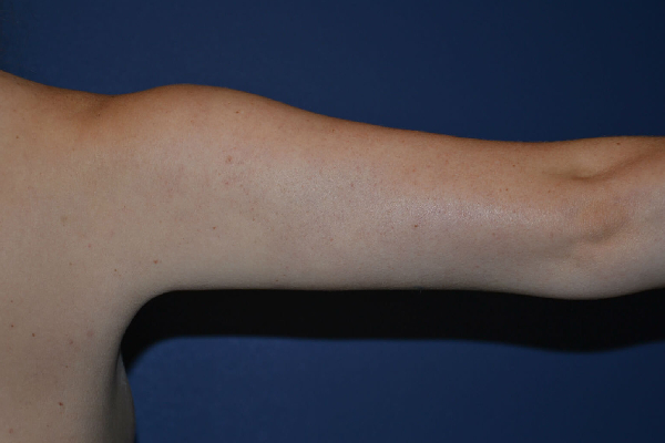 after arm lift right arm view case 4079