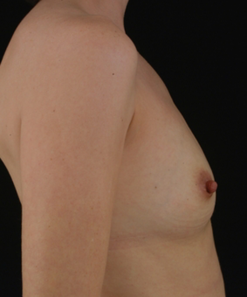 before breast augmentation right side view case 5299