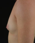 before breast augmentation left side view case 5411