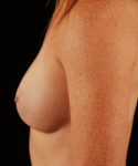 after breast augmentation left side view case 5411