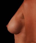 after breast augmentation left side view case 5424
