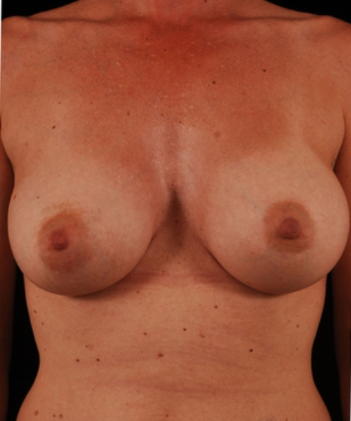 after breast augmentation front view case 5424