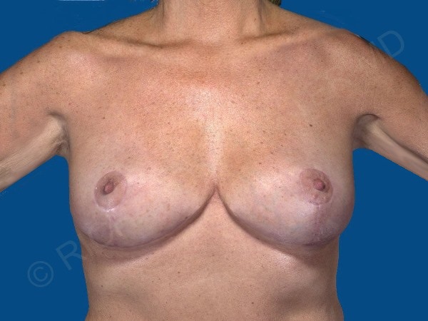 after breast implant removal front view case 4168