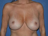 before breast implant removal front view case 4168