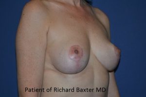 after breast implant removal right angle view case 4173