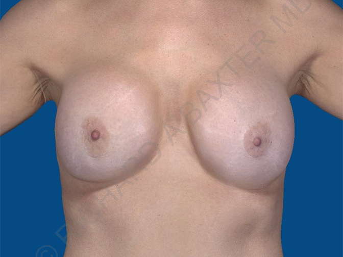 before breast implant removal front view case 4146