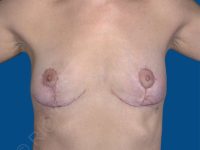 after breast implant removal front view case 4146