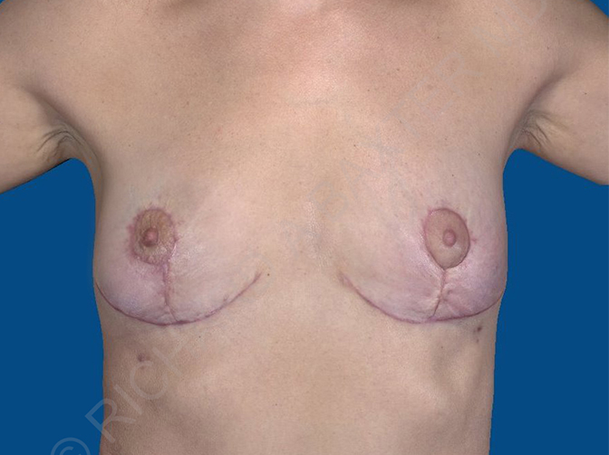 after breast implant removal front view case 4146