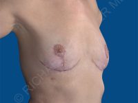 after breast implant removal right angle view case 4146