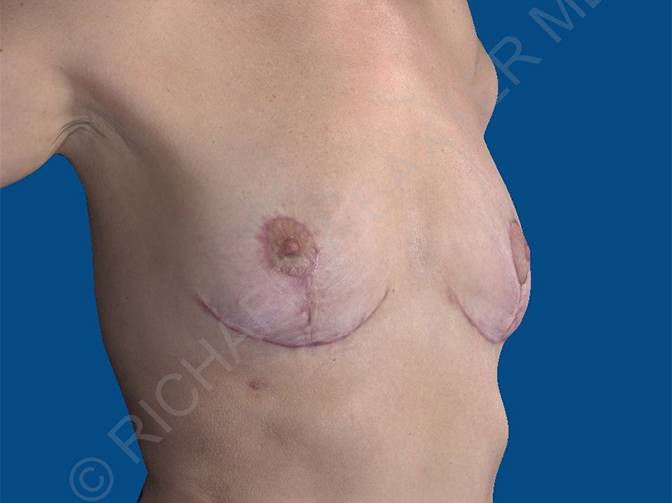 after breast implant removal right angle view case 4146