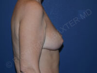 after breast implant removal right side view case 4155