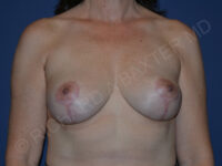 after breast implant removal front view case 4163