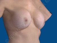 before breast implant removal right angle view case 4146